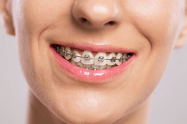 Aparat dentar pentru zâmbetul tău strălucitor: beneficii, tipuri și costuri